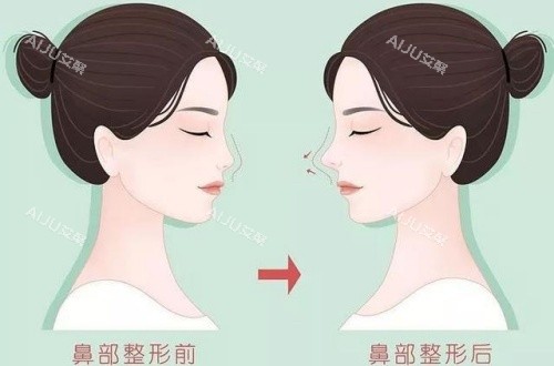 郑永生隆鼻术后漫画示意图