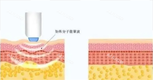 热玛吉项目皮肤剖面图