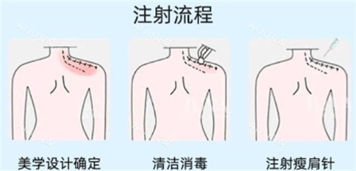 瘦肩注射点位图