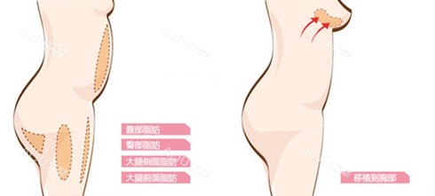 自体脂肪隆胸图
