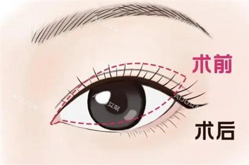 大连刘志刚双眼皮修复手术对比