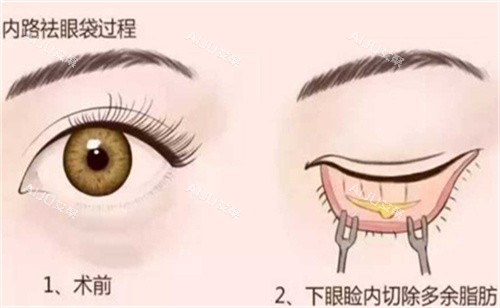 生王英俊内切法祛眼袋手术