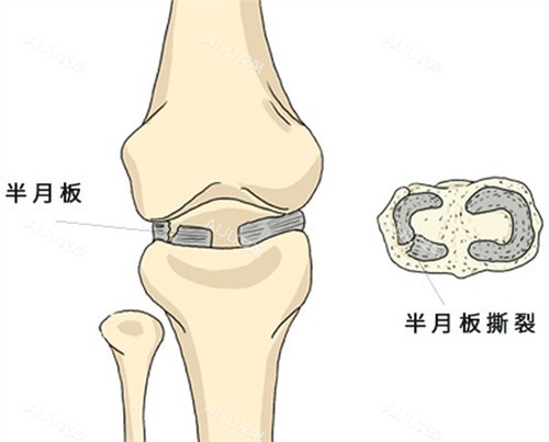 半月板撕裂图示