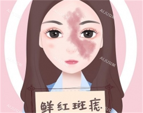什么是鲜红斑痣