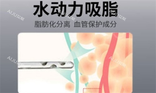 水动力吸脂