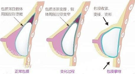 假体隆胸包膜挛缩