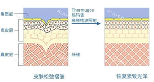 热玛吉作用在皮肤上皮下组织展示