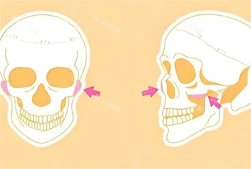 重庆潘宝华颧骨手术磨骨部位骨头演示动画图