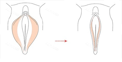 女性私密手术外阴动画展示