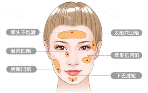 郑州管城中医院整形科面部脂肪填充适应症