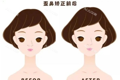 假体鼻子歪斜矫正前后示意图
