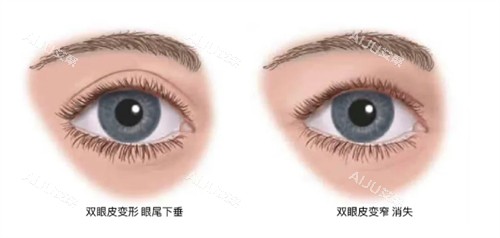 什么情况下要提眉