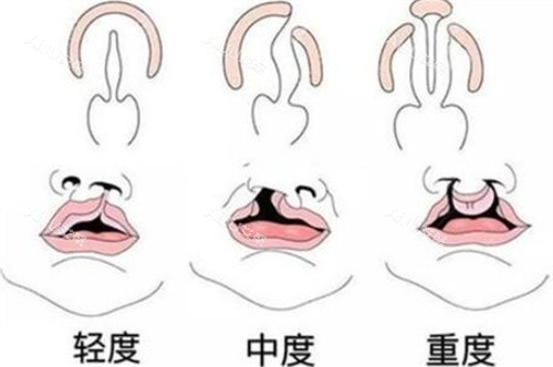库尔勒奥蕊斯唇腭裂按不同程度划分