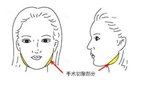 面部磨骨手术示意图