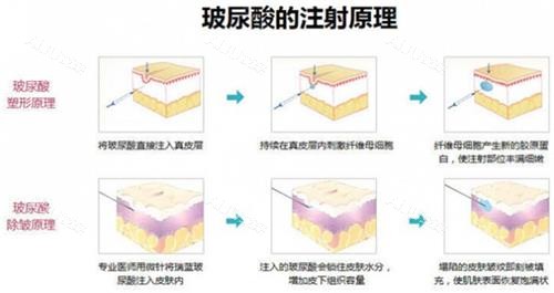 杭州蒋铮铮与梁敏雪玻尿酸注射原理