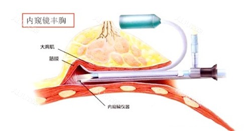 丰胸卡通图