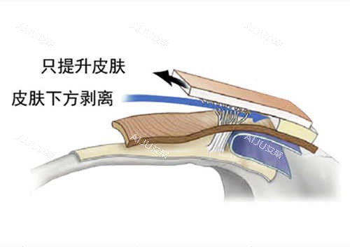SMAS筋膜层图片