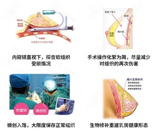 张立斌奥美定取出示意图