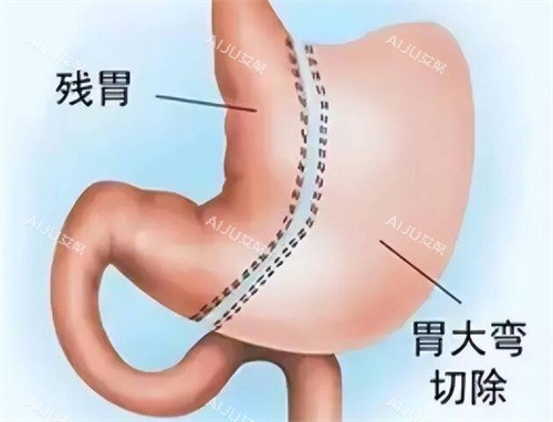 袖状胃切除手术改善展示图