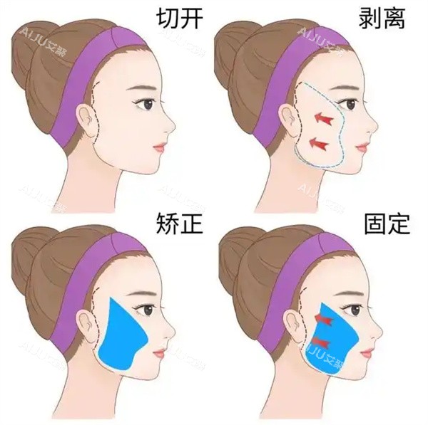 面部拉皮整形手术