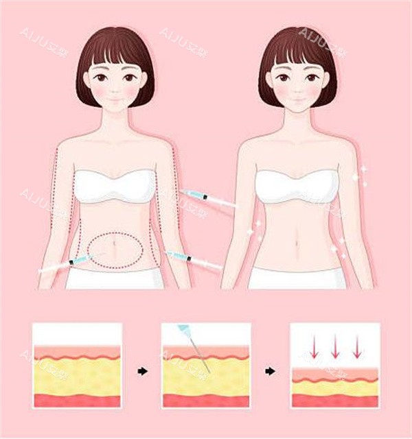 腰腹吸脂对比