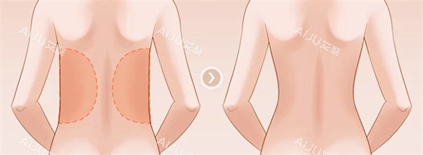 背部吸脂