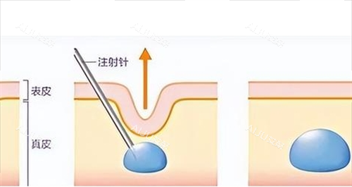 玻尿酸注射皮肤前后对比