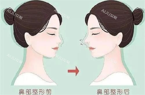 南京米兰柏羽液态隆鼻前后的区别