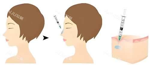 南京米兰柏羽隆鼻玻尿酸原理
