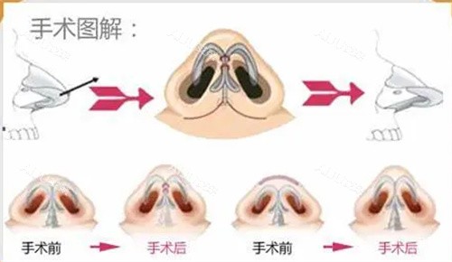 陈文杰医生鼻翼手术细节图