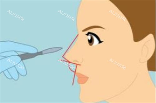 重庆曹吕梅鼻部角度展示图图 重庆曹吕梅鼻部角度展示图图