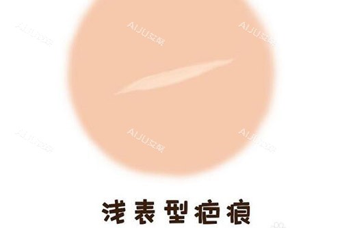 杨东运浅表型疤痕修复改善 杨东运浅表型疤痕修复改善