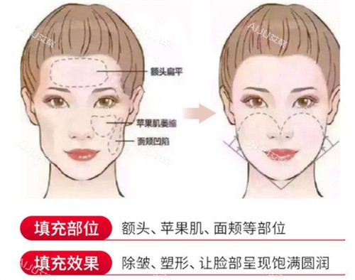 任学会和王自谦面部脂肪填充部位