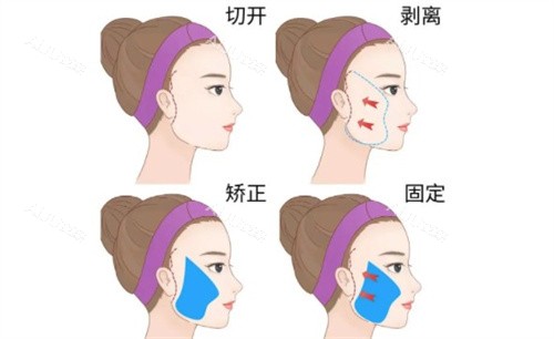 北京赵希军拉皮手术 北京赵希军拉皮手术