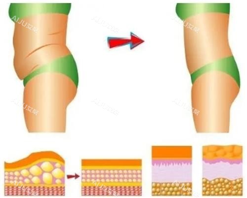 吸脂过程前后示意图 吸脂过程前后示意图