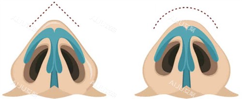 想找杨万忠隆鼻的集美看过来~现在可以公众号、线上、电话预约杨万忠医生做鼻子