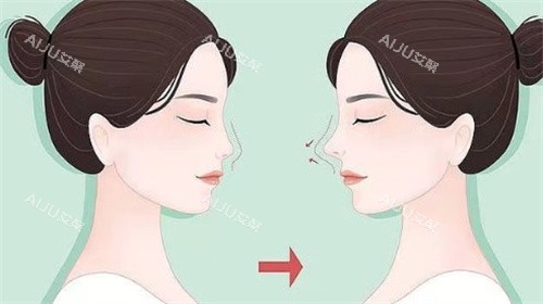 李信锋鼻修复对比 李信锋鼻修复对比