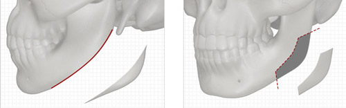 去下颌角改脸型就找张笑天！从三维重建模拟设计、多年磨骨技术沉淀，术前预见结果，术后脸型惊艳！