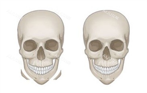 下颌角整形 下颌角整形