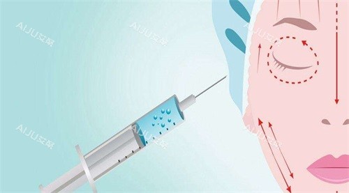 石亚矗注射玻尿酸示意图