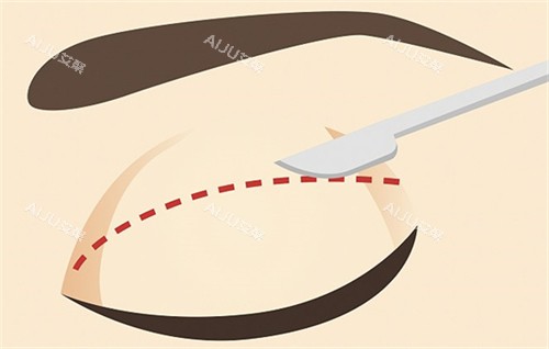 黄在弘医生双眼皮的切口切线 黄在弘医生双眼皮的切口切线