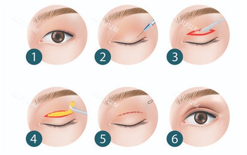 黄在弘医生双眼皮全切手术过程 黄在弘医生双眼皮全切手术过程