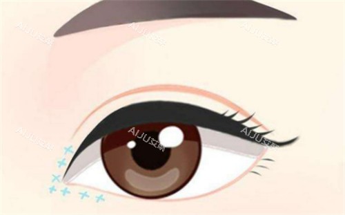 南京裴旭芳在华美做的眼综合手术到底咋样？手法精细，术后结果自然，患者反馈挺不错