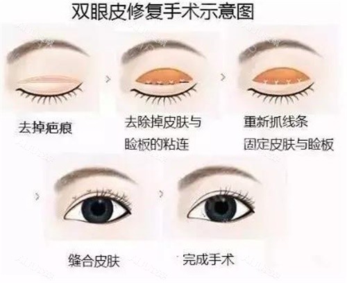 张安利医生双眼皮修复示意图 张安利医生双眼皮修复示意图