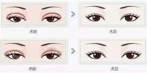 成都林靖做眼修复技术如何？手法精细经验足，术后结果自然患者都夸好