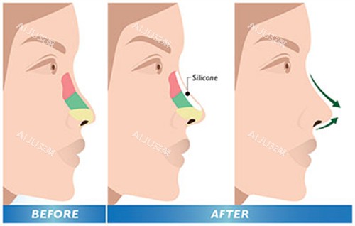 曹海峰鼻整形前后对比 (2) 曹海峰鼻整形前后对比 (2)