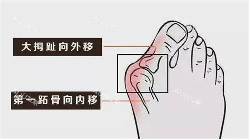马桂文和苏敬达大脚骨谁更腻害？看技术经验、患者反馈，各有专长难分高下