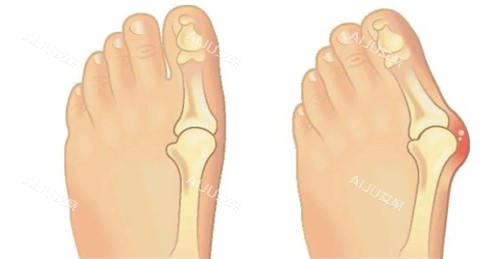 马桂文和苏敬达大脚骨手术 马桂文和苏敬达大脚骨手术