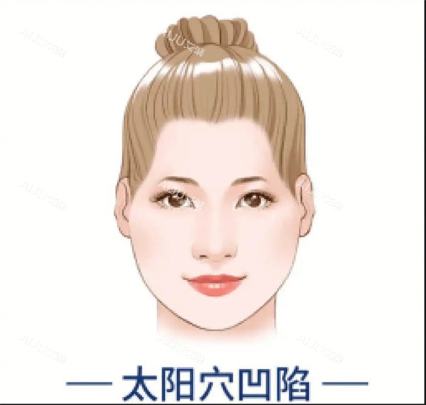 太阳穴凹陷