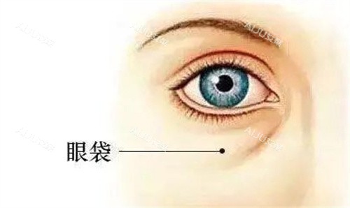 眼袋 眼袋